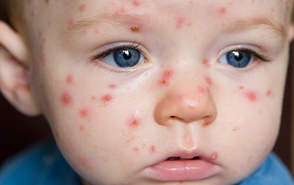 Dấu hiệu nhận biết trẻ nhỏ bị sốt phát ban